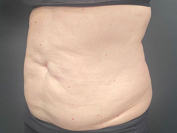 Emsculpt Neo Before & After