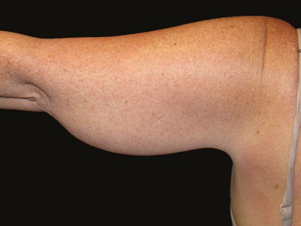 Emsculpt Neo Before & After