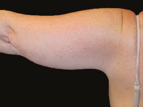 Emsculpt Neo Before & After