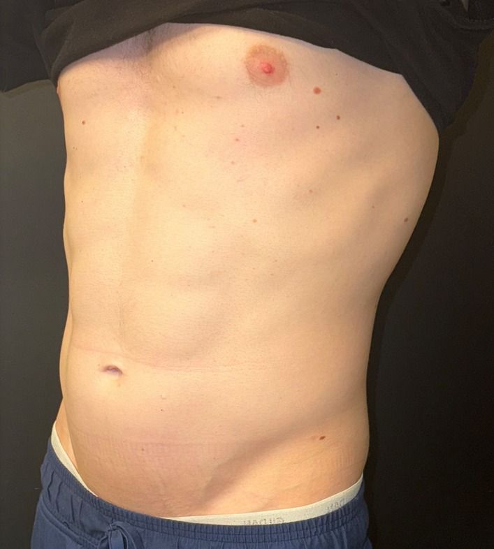 EMSCULPT NEO Before & After