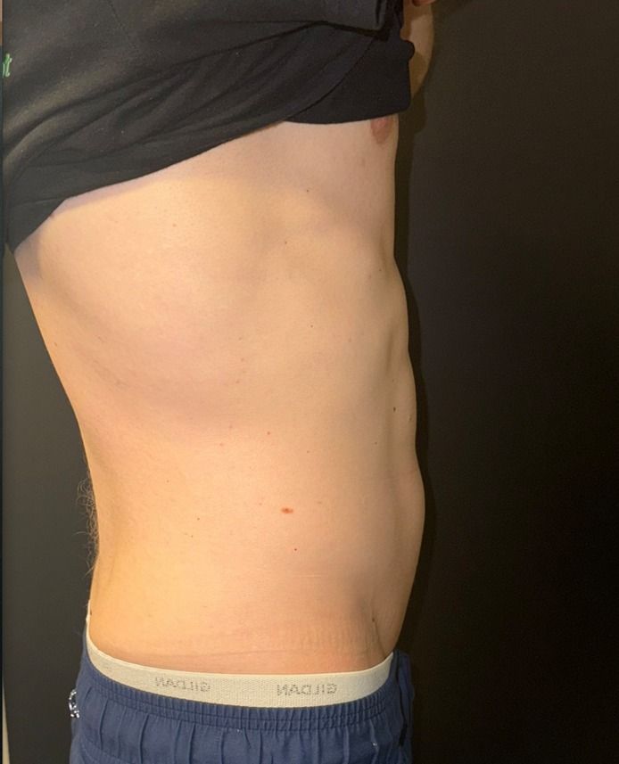 EMSCULPT NEO Before & After