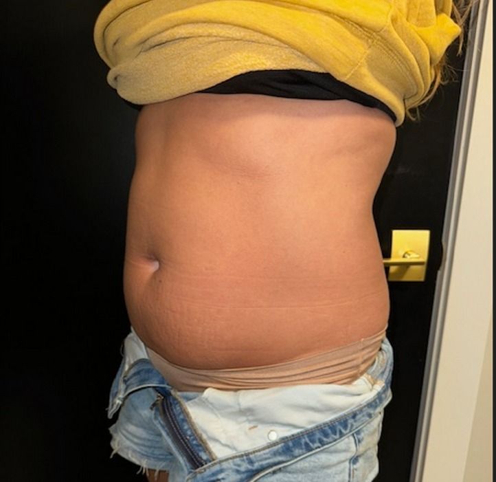 EMSCULPT NEO Before & After