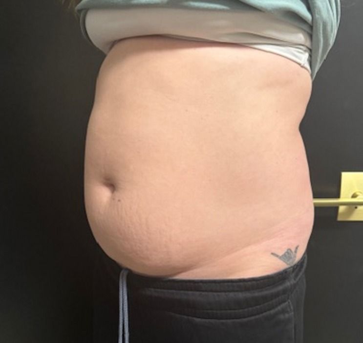 EMSCULPT NEO Before & After