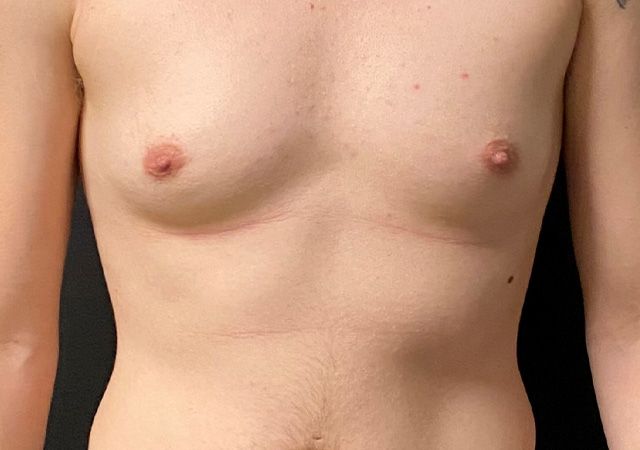 Top Surgery Before & After