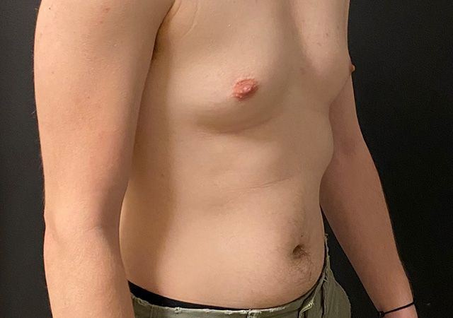 Top Surgery Before & After