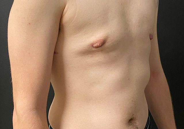 Top Surgery Before & After