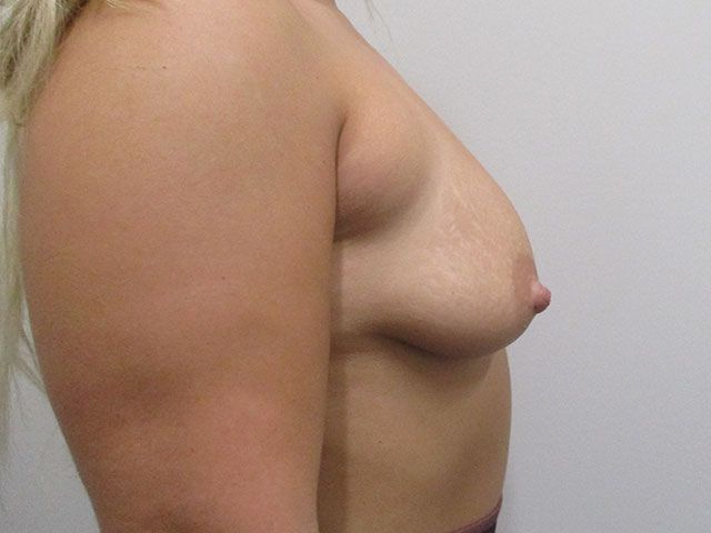 Breast Augmentation And Lift Before & After