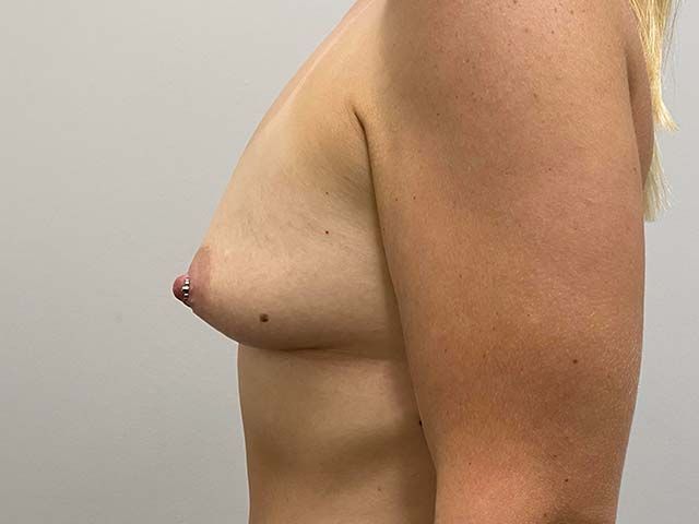 Breast Augmentation And Lift Before & After