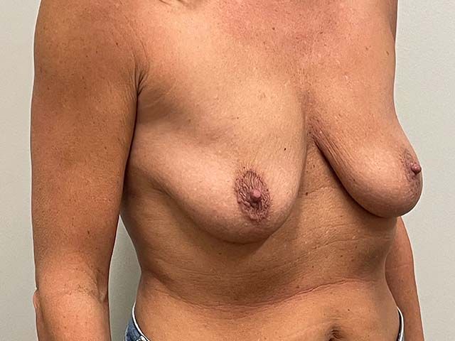 Breast Augmentation And Lift Before & After