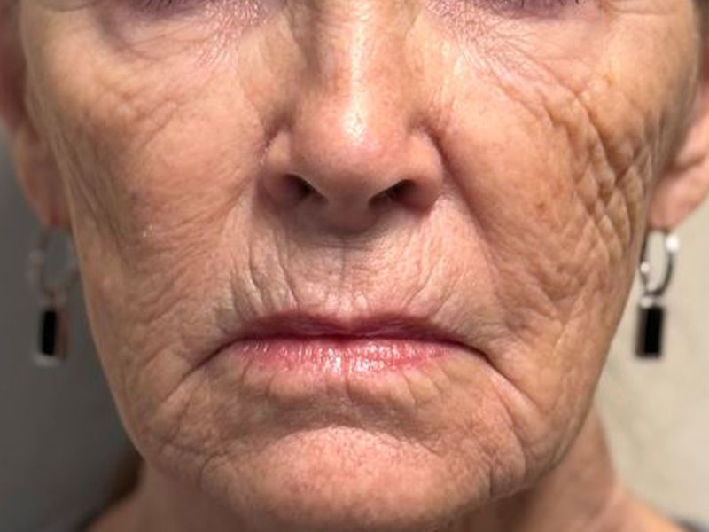 Hyperdilute Radiesse Before & After