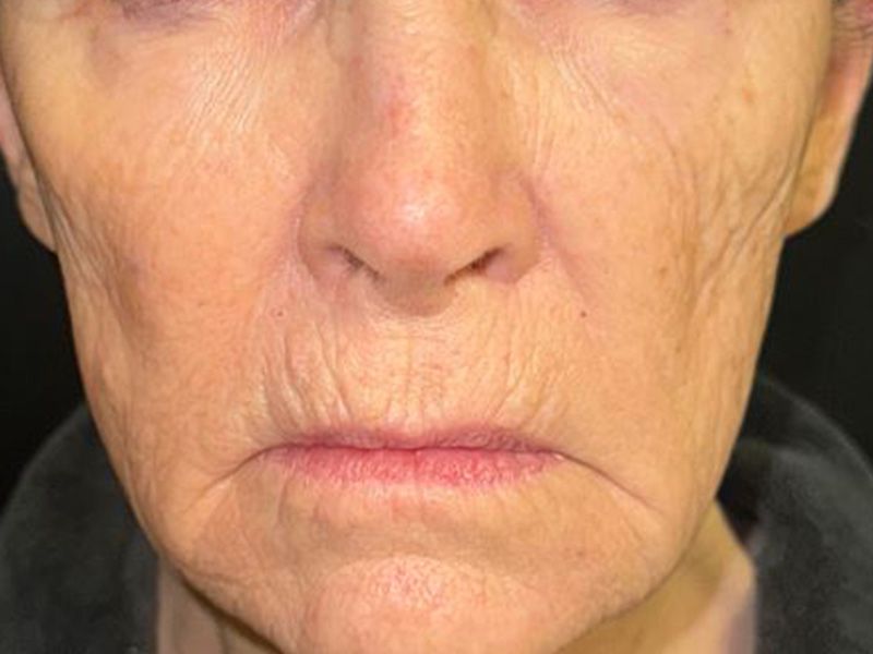 Hyperdilute Radiesse Before & After