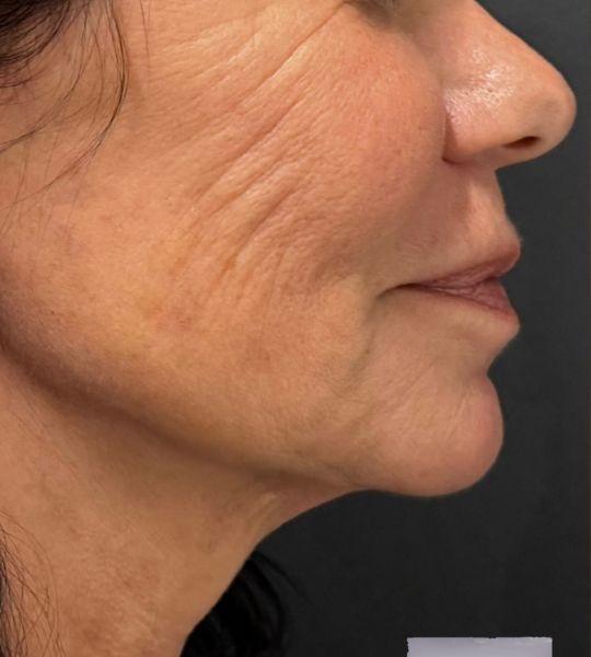 Hyperdilute Radiesse Before & After