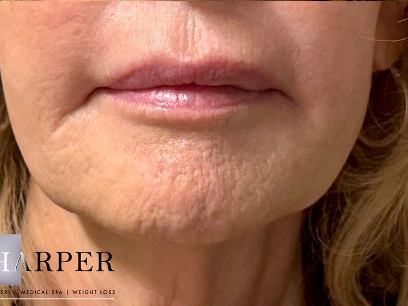 Hyperdilute Radiesse Before & After