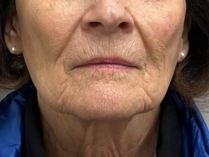 Hyperdilute Radiesse Before & After