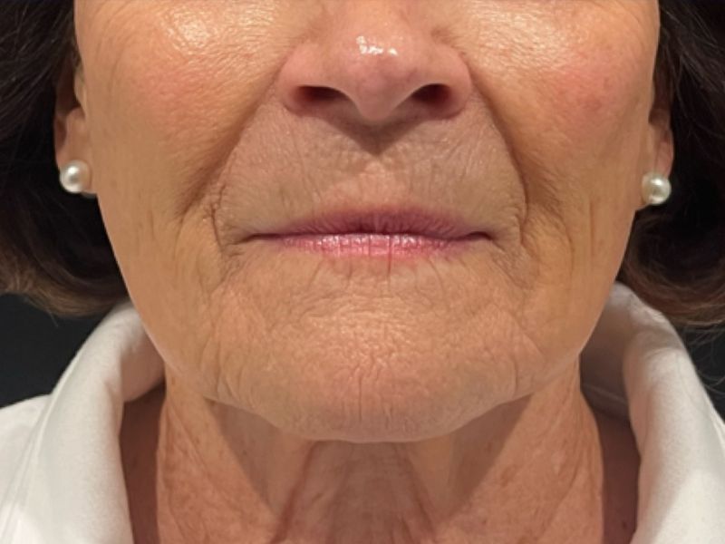 Hyperdilute Radiesse Before & After