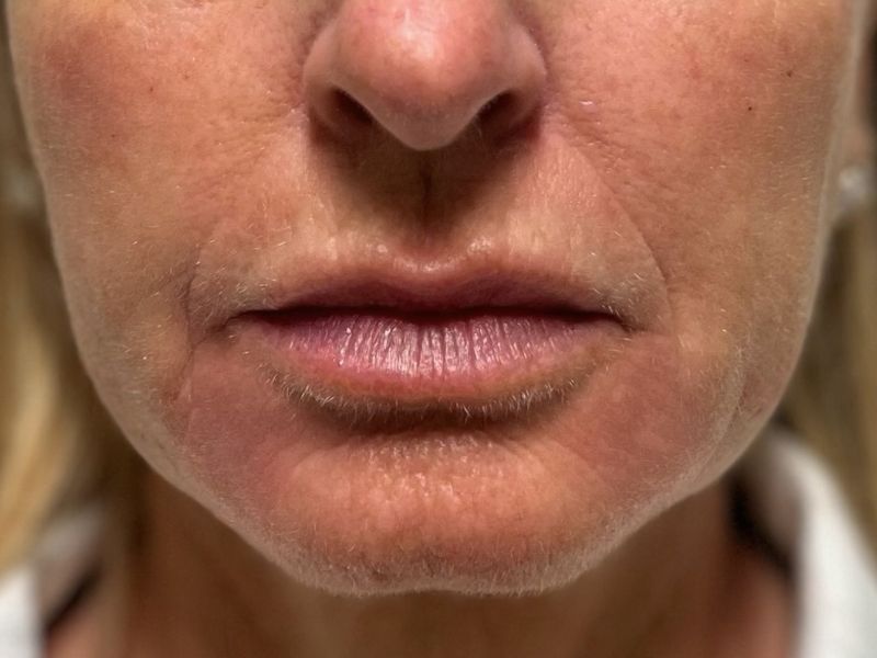 Hyperdilute Radiesse Before & After