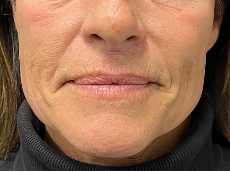 Hyperdilute Radiesse Before & After