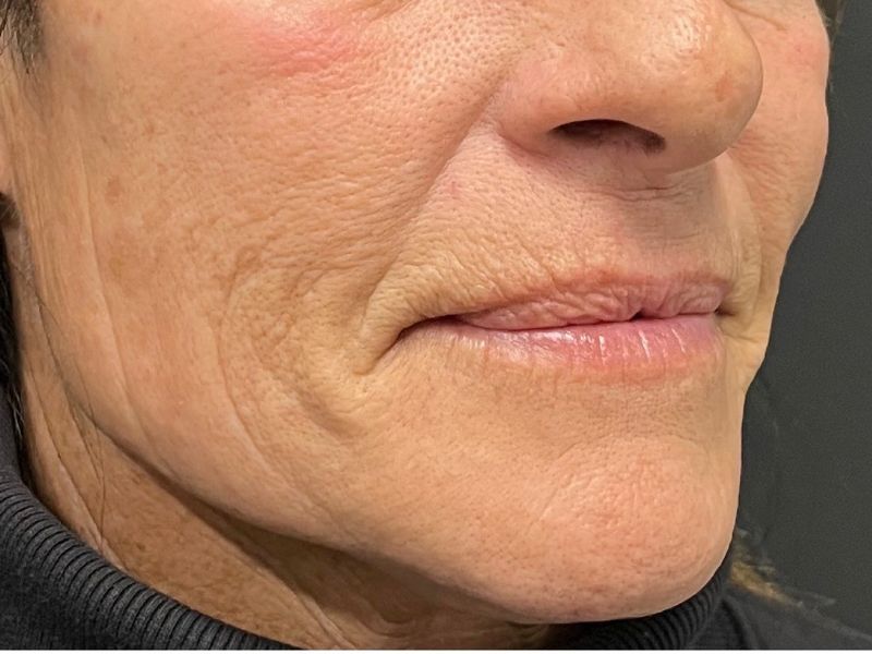 Hyperdilute Radiesse Before & After