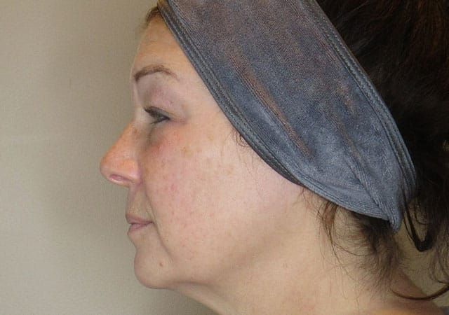 Morpheus8 Before & After