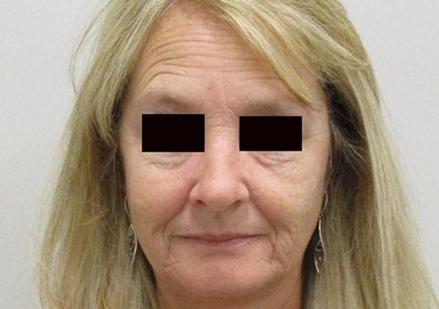 Morpheus8 Before & After