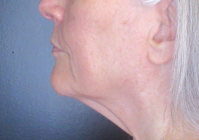 Morpheus8 Before & After