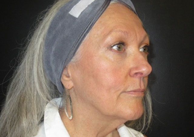 Morpheus8 Before & After