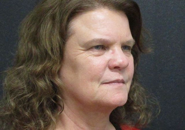 Morpheus8 Before & After