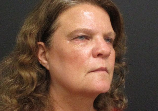 Morpheus8 Before & After