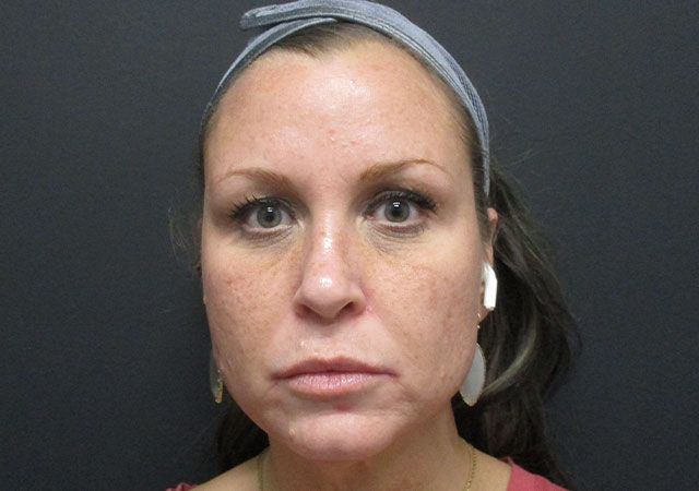 Morpheus8 Before & After