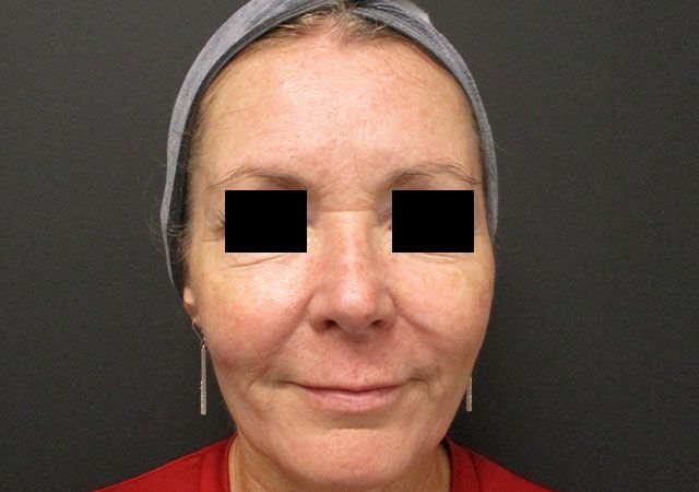 Morpheus8 Before & After