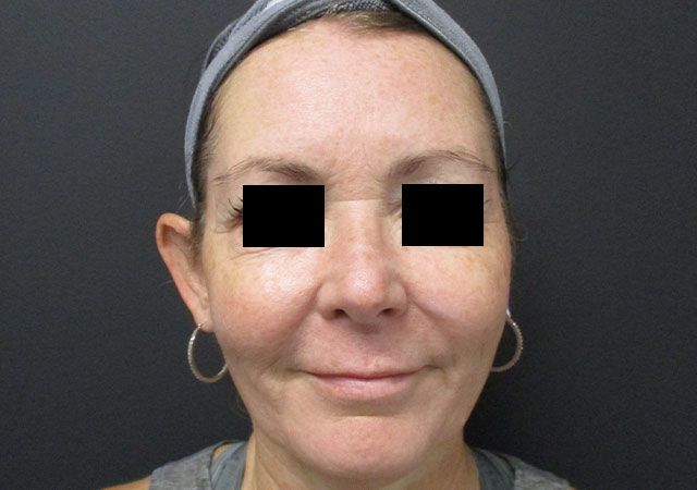 Morpheus8 Before & After