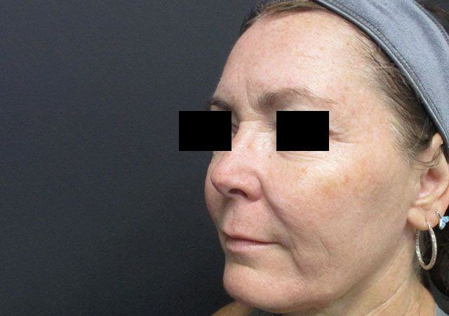 Morpheus8 Before & After