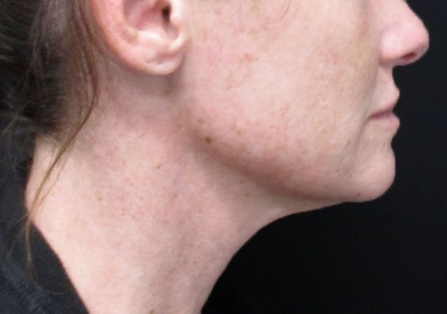 Morpheus8 Before & After