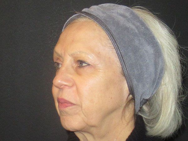 Morpheus8 Before & After