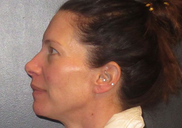 Morpheus8 Before & After