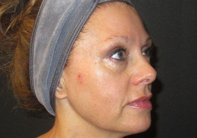 Morpheus8 Before & After