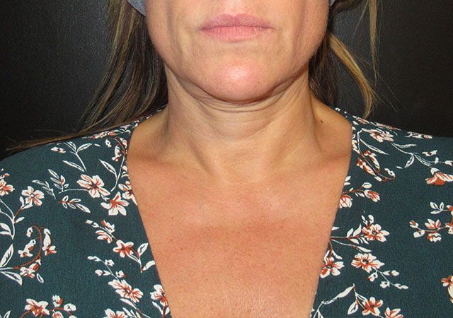 Morpheus8 Before & After