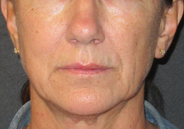 Morpheus8 Before & After