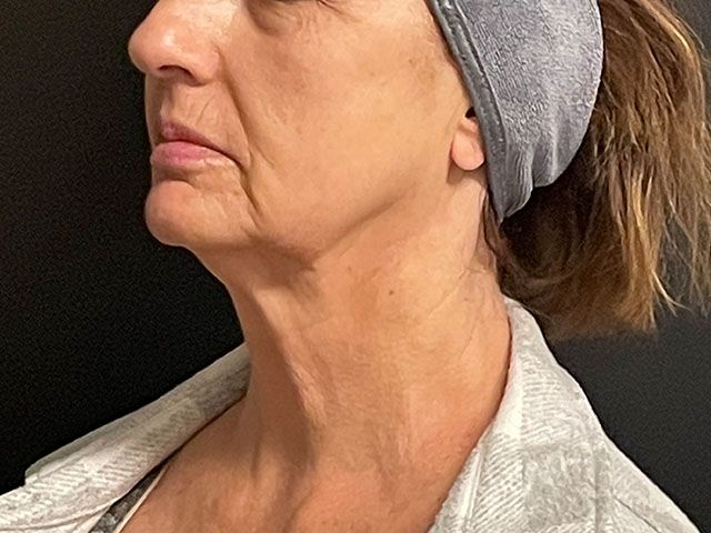 Morpheus8 Before & After