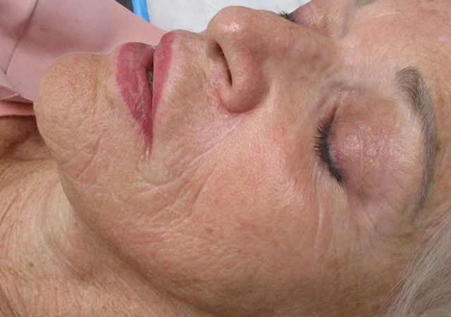 Morpheus8 Before & After