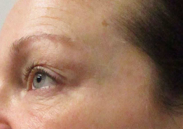 Morpheus8 Before & After