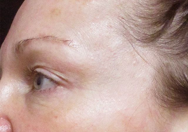 Morpheus8 Before & After