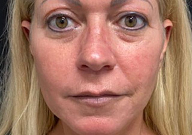 Morpheus8 Before & After