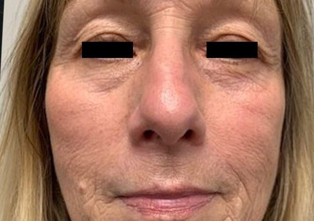 Morpheus8 Before & After