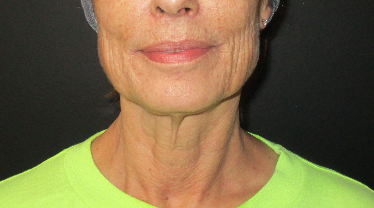 Morpheus8 Face Before & After