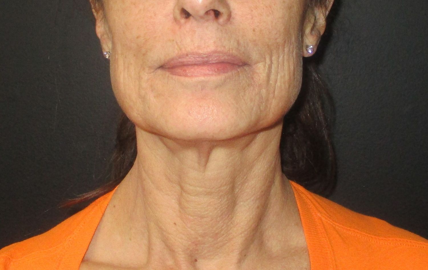 Morpheus8 Face Before & After