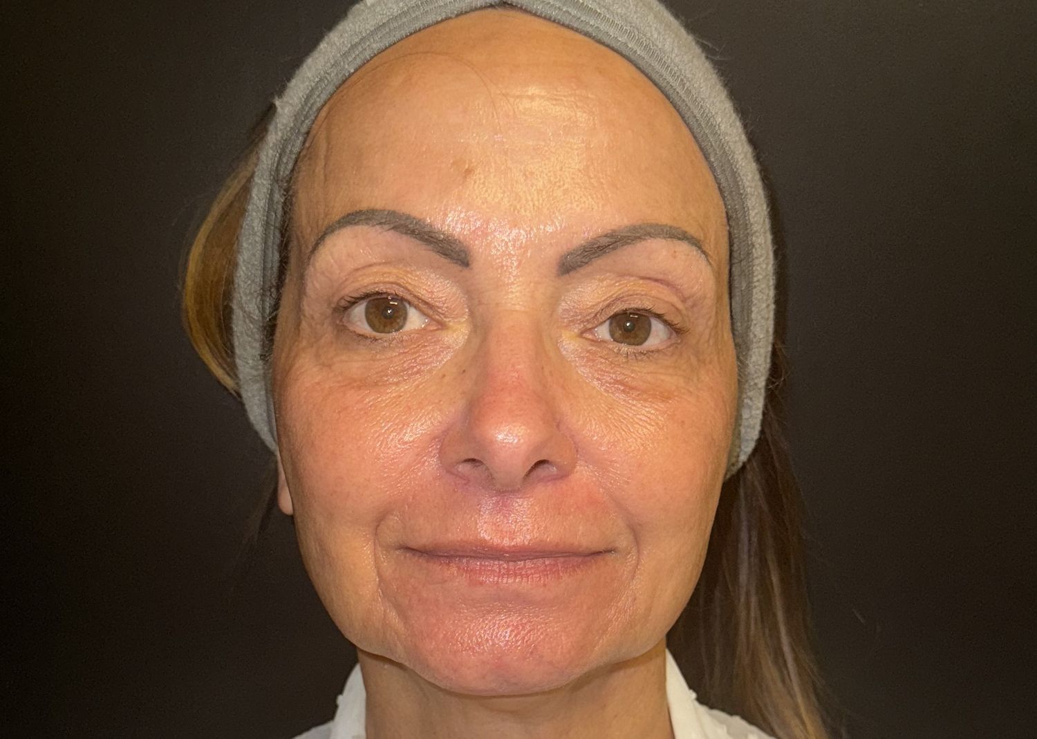 Morpheus8 Face Before & After