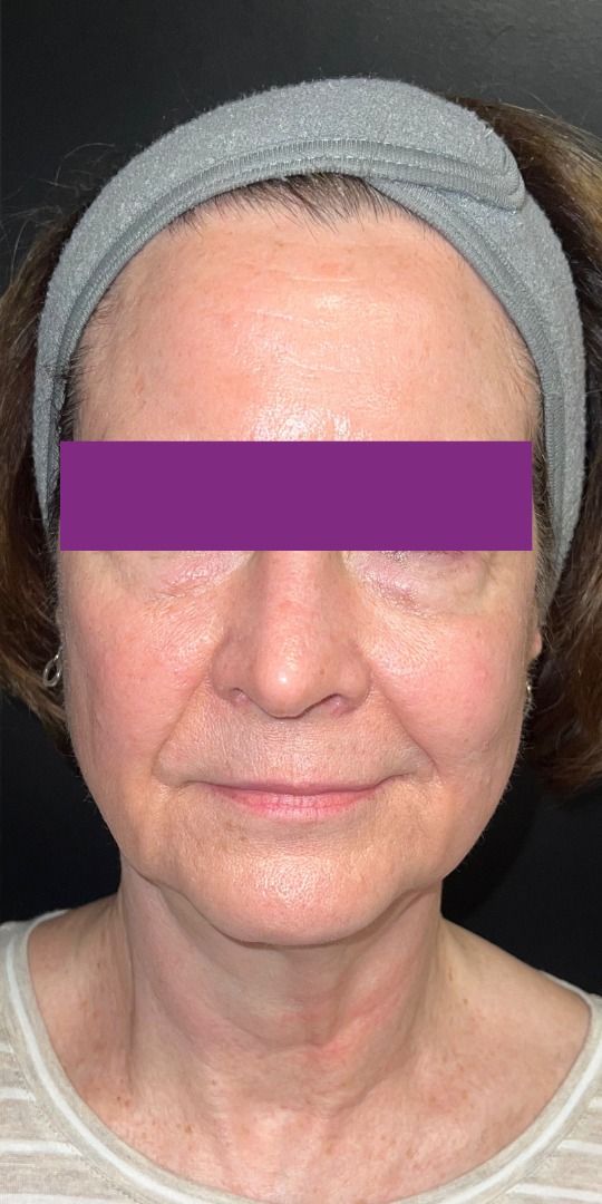 Morpheus8 Face Before & After