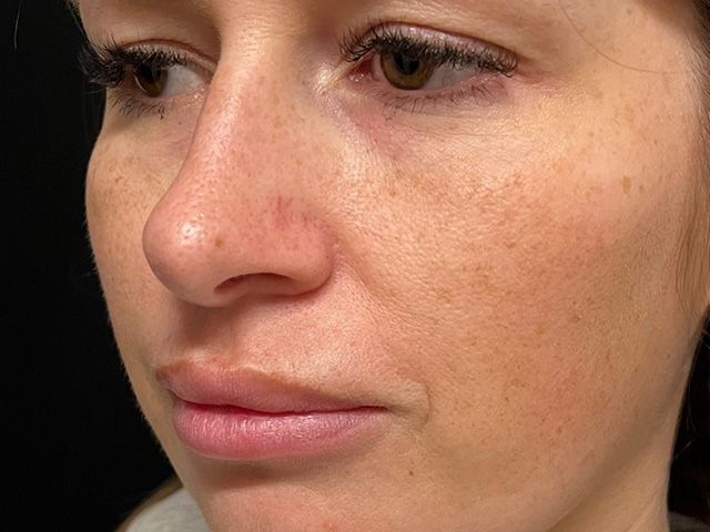 Cheeks Before & After