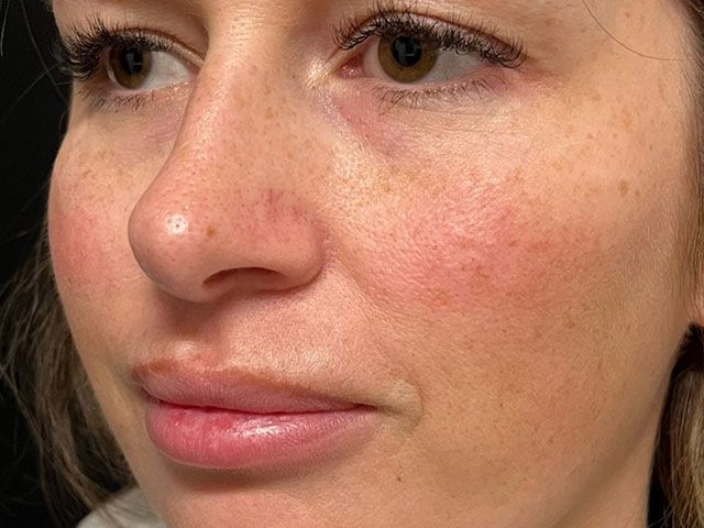 Cheeks Before & After